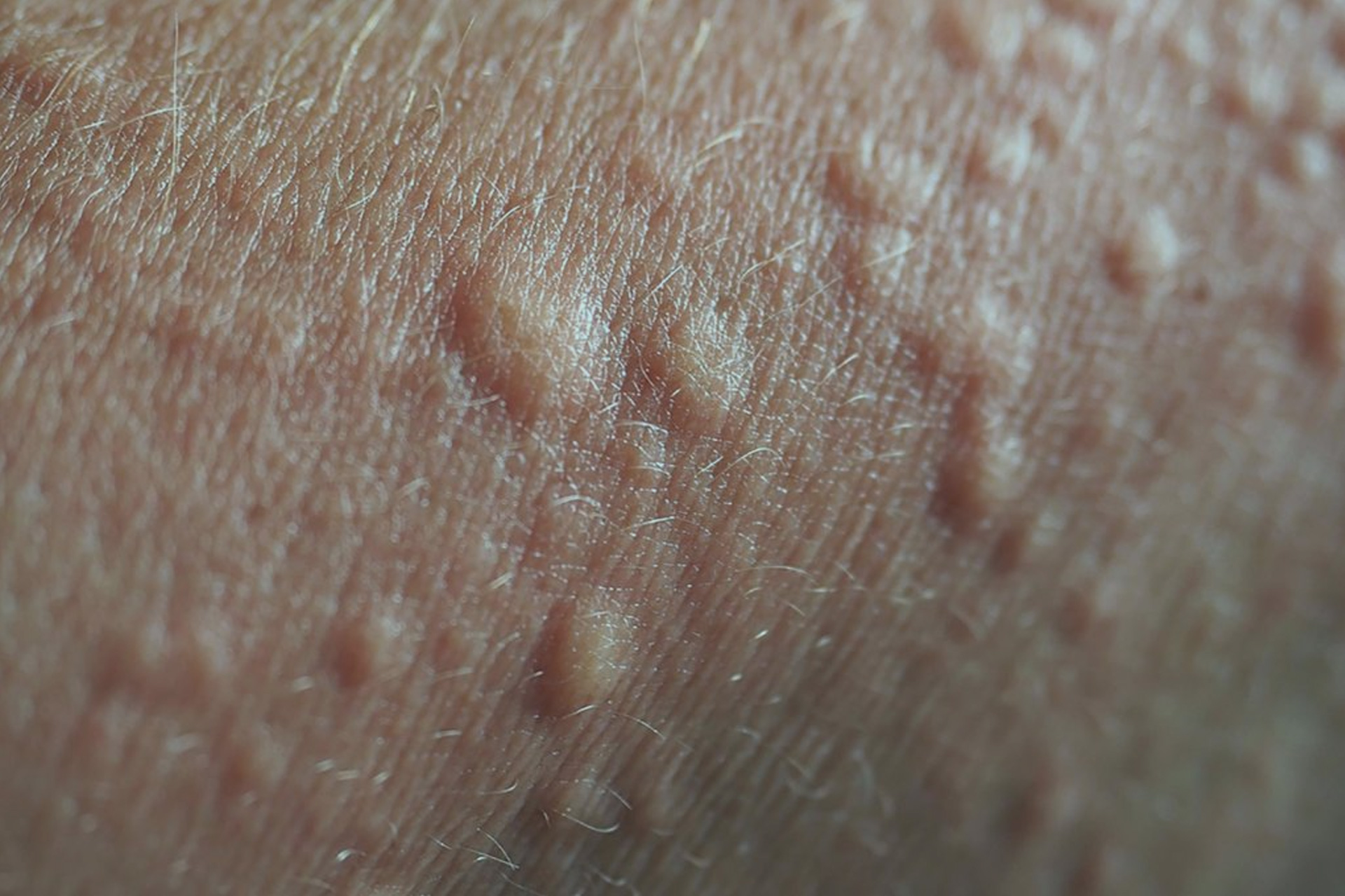 procedure udstrømning Elendig Preventing Bumps – My Brazilian Wax